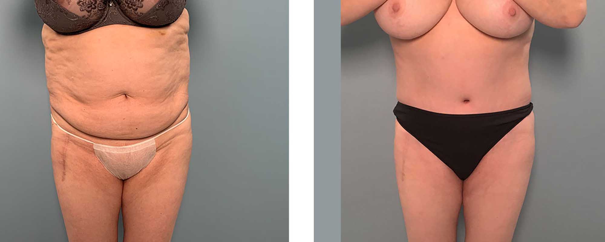 7 Tips For Tummy Tuck Recovery